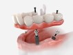 Dental implants treatment in Dubai UAE