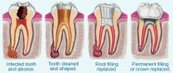 Root Canal Treatment in Dubai UAE