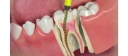 Root Canal Treatment in Dubai At AED 600