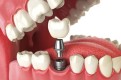 Dental Implant in Dubai