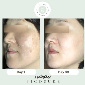 PicoSure treatment Abu Dhabi | بيكوشور | Picosure Tattoo Removal