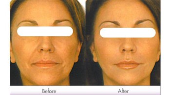 Non-Surgical Face Lift in Dubai