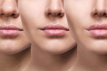 Lip Enhancement Dubai