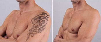 Permanent Laser Tattoo Removal Treatment