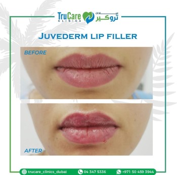 Lip Fillers Dubai