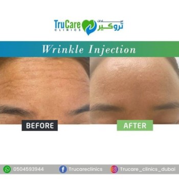 Facial Fillers Dubai