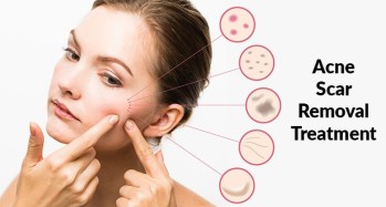 Acne Scar Treatment in Hyderabad