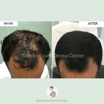 Hair treatment in Abu Dhabi | hair transplant | hair treatment