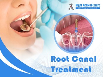 Tooth Filling - Root Canal Treatment in Sharjah, Abu Shagara