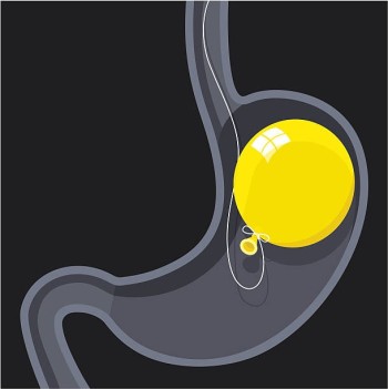 Cheapest Gastric Balloon Surgery in Dubai