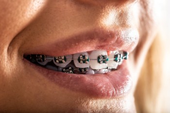 Affordable braces in Dubai