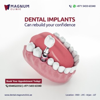 Magnum Dental Clinic - Dental Implants in Dubai