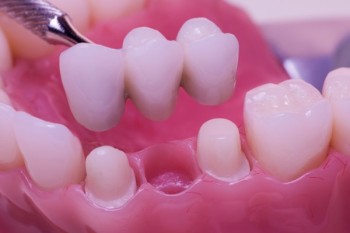 Best Dental Bridge treatments clinic in Dubai UAE