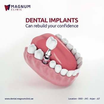 Magnum Dental Clinic - Best Dental Implant in Dubai