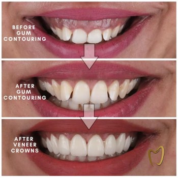 Best Gum contouring treatment clinic in Dubai UAE