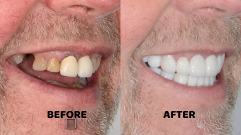 effective solutions for how to fix gap teeth