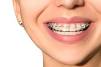 how to fix gap teeth in dubai