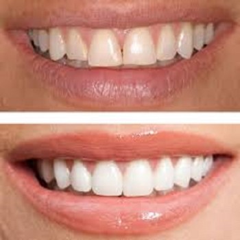 Best Dental Bonding clinic in Dubai UAE