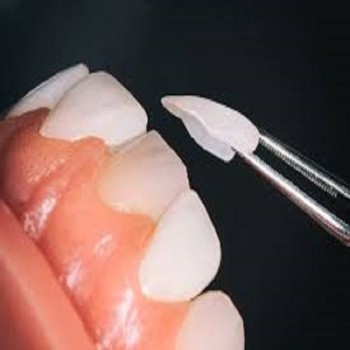 Best Dental laminate treatment clinic in Dubai UAE