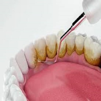 Best Dental scaling treatment in Dubai UAE