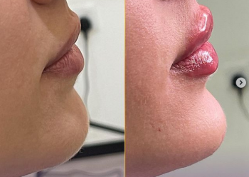 Russian Lip Fillers in Dubai