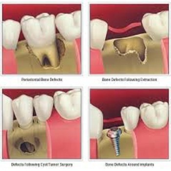 Best Periodontal bone grafts treatment in Dubai UAE