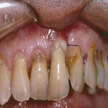 Best Gum disease clinic in Dubai UAE