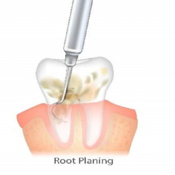 Best Root planning clinic in Dubai UAE