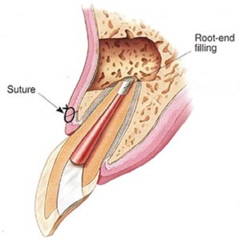 Best Root end surgery treatment in Dubai UAE