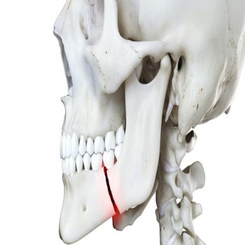 Best Jaw Fractures treatment in Dubai UAE