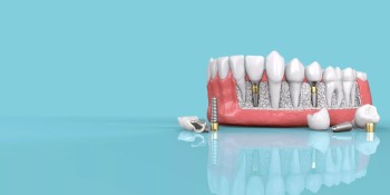 Expert Dental Care in Dubai: Your Path to a Healthier, Brighter Smile