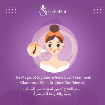 Signature acne scar treatment by bellaphi