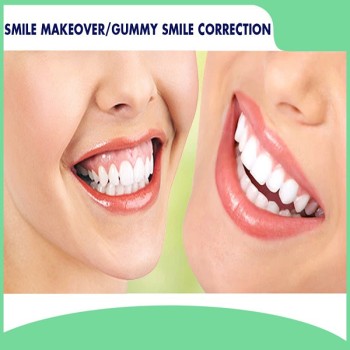 Best Smile Makeover treatment in Dubai UAE