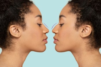 Rhinoplasty Surgery 1