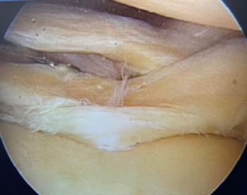 Meniscal Surgery In Dubai | Best Knee Doctor In Dubai- Dr Rik Kundra