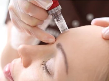 Dermapen Mesotherapy in Sharjah