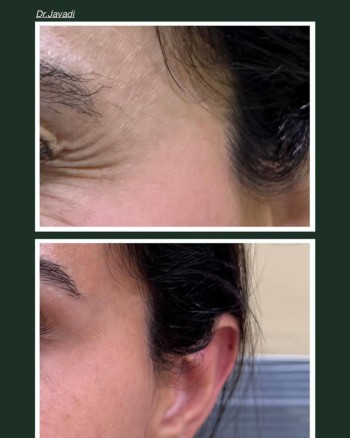Neuromodulators is a highly effective treatment for crow’s feet—those fine lines and wrinkles ar