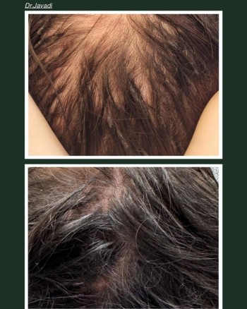 Combination therapy is often the most effective approach for treating androgenic alopecia, as it