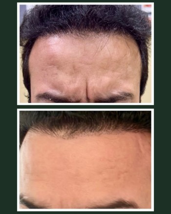 Preventing static lines in men with Neuromodulators requires a precise approach, Men’s facial mu