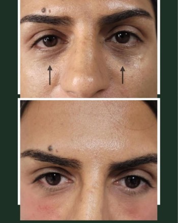 Under-eye treatment using the Cannula technique with a Minimal dosage of Hyaluronic Acid Filler,
